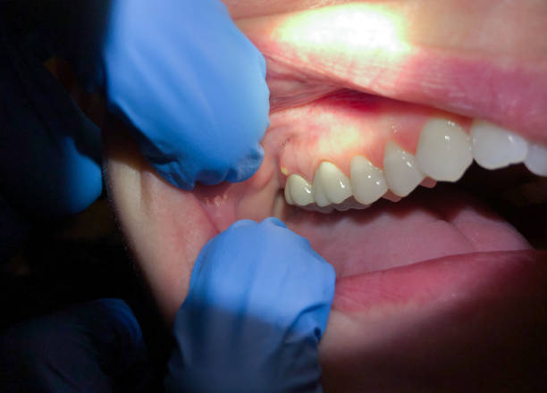 Best Emergency Dental Care for Abscessed Tooth in Lapeer, MI