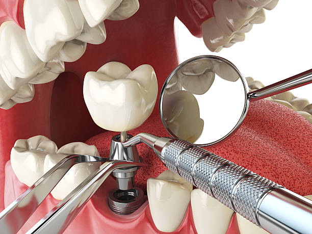 Best Emergency Dentist for Lost Fillings or Crowns in Lapeer, MI