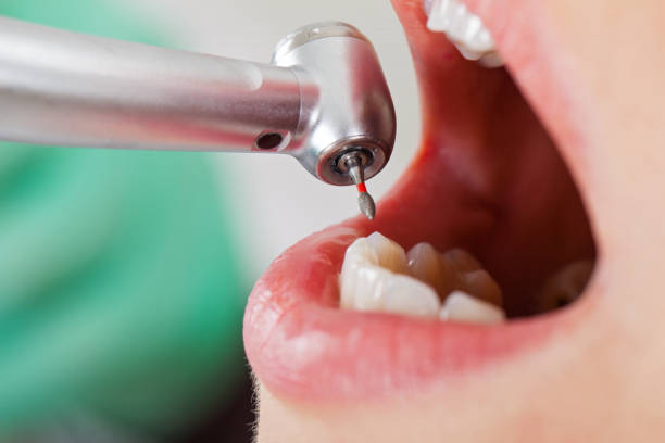 Best Broken or Cracked Tooth Emergency Dentist in Lapeer, MI